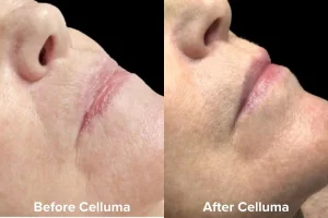 Aging_B_A_Female_Side_Lip_Images_courtesy_of_Lori_Hall_LE_1080_x_720px_d4e785f1-9dba-4d2a-82e7-ed89a8cfe006 - Elmira Studio