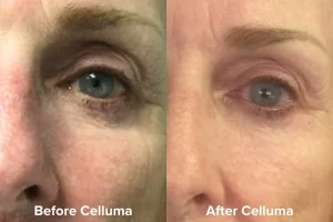 Aging_B_A_Female_Under_Eyes_1080_x_720px_dafdf51f-cfaa-4162-9651-ed69b2f1fff3 - Elmira Studio